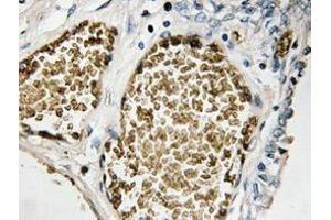 Immunohistochemistry analyzes of FosB antibody in paraffin-embedded human prostate carcinoma tissue. (FOSB Antikörper)