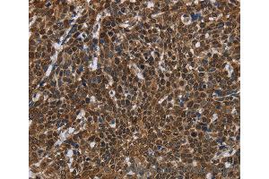 Immunohistochemistry of Human esophagus cancer using FASTKD2 Polyclonal Antibody at dilution of 1:50