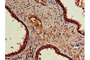Immunohistochemistry of paraffin-embedded human prostate cancer using ABIN7161911 at dilution of 1:100 (NR5A2 + LRH1 Antikörper  (AA 182-291))