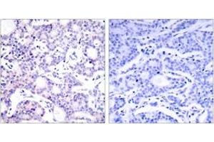 Immunohistochemistry analysis of paraffin-embedded human breast carcinoma tissue, using NF-kappaB p105/p50 (Ab-893) Antibody. (NFKB1 Antikörper  (AA 860-909))