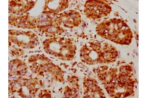 IHC image of nforHU diluted at 1:20 and staining in paraffin-embedded human breast cancer performed on a Leica BondTM system.