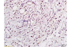 Formalin-fixed and paraffin embedded human gastric tissue labeled with Rabbit Anti-NFkB p105 / p50 Polyclonal Antibody, Unconjugated  at 1:200 followed by conjugation to the secondary antibody and DAB staining (NFKB1 Antikörper  (AA 51-100))