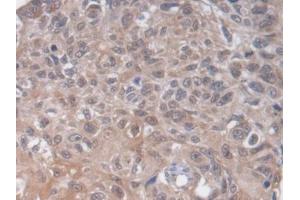 DAB staining on IHC-P; Samples: Human Lung cancer Tissue (HS2ST1 Antikörper  (AA 29-356))