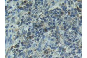 IHC-P analysis of Human Esophagus Cancer Tissue, with DAB staining. (IL1R1 Antikörper  (AA 21-109))