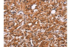 The image on the left is immunohistochemistry of paraffin-embedded Human thyroid cancer tissue using ABIN7192526(SLC8A2 Antibody) at dilution 1/15, on the right is treated with synthetic peptide. (SLC8A2 Antikörper)