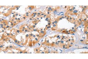 Immunohistochemistry of paraffin-embedded Human thyroid cancer tissue using BNIP3L Polyclonal Antibody at dilution 1:40 (BNIP3L/NIX Antikörper)