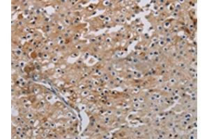 The image on the left is immunohistochemistry of paraffin-embedded Human prostate cancer tissue using ABIN7191864(PHKA2 Antibody) at dilution 1/30, on the right is treated with synthetic peptide. (PHKA2 Antikörper)