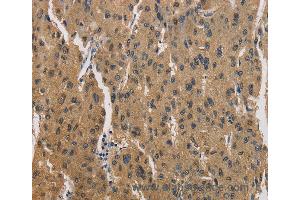 Immunohistochemistry of Human liver cancer using CKMT2 Polyclonal Antibody at dilution of 1:60 (CKMT2 Antikörper)