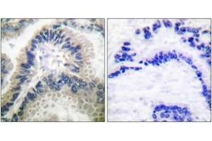 Immunohistochemistry analysis of paraffin-embedded human lung carcinoma tissue, using Guanylate Cyclase beta Antibody. (GUCYB Antikörper  (AA 10-59))