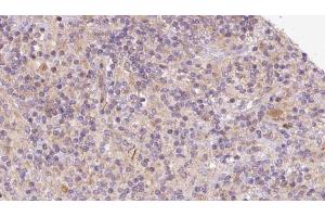 ABIN6273099 at 1/100 staining Human lymph cancer tissue by IHC-P. (CHCHD6 Antikörper  (Internal Region))