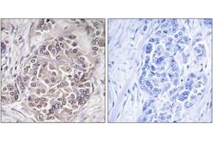 Immunohistochemistry analysis of paraffin-embedded human breast carcinoma tissue, using PEX1 Antibody. (PEX1 Antikörper  (AA 1234-1283))