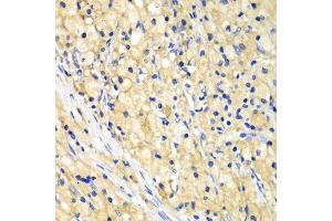Immunohistochemistry of paraffin-embedded human lung cancer using NUP62 antibody. (NUP62 Antikörper  (AA 403-522))