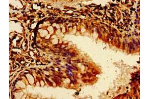 Immunohistochemistry of paraffin-embedded human lung cancer using ABIN7174072 at dilution of 1:100 (ROR2 Antikörper  (AA 752-926))