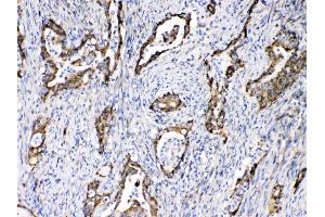 TECTA was detected in paraffin-embedded sections of human intetsinal cancer tissues using rabbit anti- TECTA Antigen Affinity purified polyclonal antibody (Catalog # ) at 1 µg/mL.