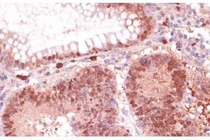 Immunohistochemistry of paraffin-embedded Human colon carcinoma using S100P Polyclonal Antibody at dilution of 1:100 (40x lens). (S100P Antikörper)