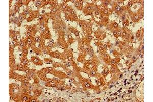 Immunohistochemistry of paraffin-embedded human liver cancer using ABIN7149214 at dilution of 1:100 (Cytochrome P450, Family 2, Subfamily A, Polypeptide 1 (CYP2A1) (AA 91-390) Antikörper)