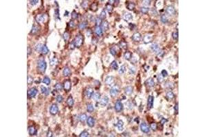 IHC analysis of FFPE human hepatocarcinoma tissue stained with the YY1 antibody (YY1 Antikörper  (AA 268-297))