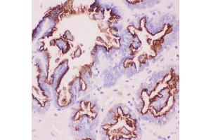 Anti-MUC1 Picoband antibody,  IHC(P): Human Ovary Cancer Tissue (MUC1 Antikörper  (AA 935-1097))