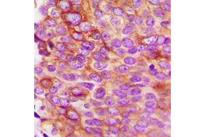 Immunohistochemical analysis of IL-5 staining in human breast cancer formalin fixed paraffin embedded tissue section. (IL-5 Antikörper  (Center))