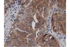 Immunohistochemical staining of paraffin-embedded Adenocarcinoma of Human breast tissue using anti-DNAJA2 mouse monoclonal antibody. (DNAJA2 Antikörper)
