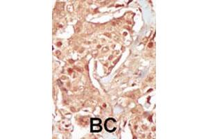 Formalin-fixed and paraffin-embedded human cancer tissue reacted with PCTK3 polyclonal antibody  , which was peroxidase-conjugated to the secondary antibody, followed by DAB staining. (CDK18 Antikörper  (N-Term))