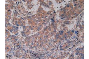 IHC-P analysis of Human Breast Cancer Tissue, with DAB staining. (CD40 Antikörper  (AA 26-187))