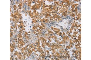 Immunohistochemistry of Human cervical cancer using DIDO1 Polyclonal Antibody at dilution of 1:60 (DIO1 Antikörper)