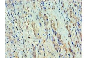 Immunohistochemistry of paraffin-embedded human colon cancer using ABIN7150384 at dilution of 1:100 (RFX5 Antikörper  (AA 367-616))