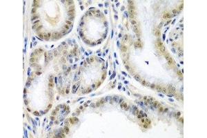 Immunohistochemistry of paraffin-embedded Human colon carcinoma using SSX2 Polyclonal Antibody at dilution of 1:200 (40x lens). (SSX2 Antikörper)