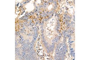 Immunohistochemistry of paraffin-embedded human colon carcinoma using MMP7 Rabbit mAb (ABIN7268425) at dilution of 1:150 (40x lens). (MMP7 Antikörper)