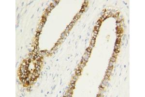 Caspase-1 antibody testing of human breast cancer tissue by IHC-P. (Caspase 1 Antikörper  (AA 249-262))