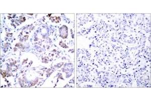 Immunohistochemistry analysis of paraffin-embedded human breast carcinoma tissue, using NF-kappaB p65 (Ab-254) Antibody.