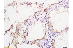Formalin-fixed and paraffin embedded human rectal carcinoma labeled with Rabbit Anti phospho-SHC(Ser36) Polyclonal Antibody, Unconjugated (ABIN745913) at 1:200 followed by conjugation to the secondary antibody and DAB staining (SHC1 Antikörper  (pSer36))