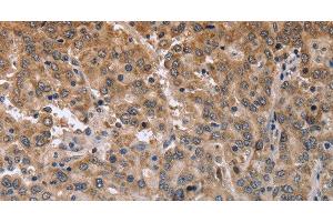 Immunohistochemistry of paraffin-embedded Human liver cancer using MAPRE3 Polyclonal Antibody at dilution of 1:50 (MAPRE3 Antikörper)