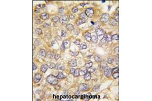 Formalin-fixed and paraffin-embedded human hepatocarcinoma tissue reacted with CHRD antibody , which was peroxidase-conjugated to the secondary antibody, followed by DAB staining.