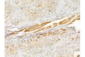 ABIN6257061 and ABIN6274183 at 1/100 staining human tongue carcinoma by IHC-P. (CKMT2 Antikörper  (Internal Region))