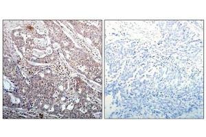 Immunohistochemical analysis of paraffin-embedded human breast carcinoma tissue using IkB-b(Phospho-Ser23) Antibody(left) or the same antibody preincubated with blocking peptide(right). (NFKBIB Antikörper  (pSer23))