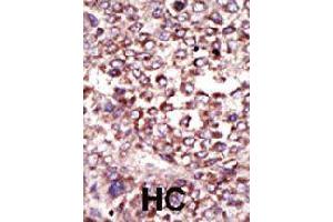 Formalin-fixed and paraffin-embedded human hepatocellular carcinoma tissue reacted with RPN2 polyclonal antibody  , which was peroxidase-conjugated to the secondary antibody, followed by DAB staining . (Ribophorin II Antikörper  (N-Term))