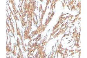 Formalin-fixed, paraffin-embedded human Leiomyosarcoma stained with alpha Smooth Muscle Actin antibody (ACTA2/791). (Smooth Muscle Actin Antikörper)