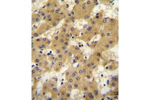 OF antibody (Center) 10107c immunohistochemistry analysis in formalin fixed and paraffin embedded human hepatocarcinoma followed by peroxidase conjugation of the secondary antibody and DAB staining. (Apolipoprotein F Antikörper  (AA 111-138))