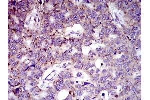 Immunohistochemical analysis of paraffin-embedded esophageal cancer tissues using MRPL42 mouse mAb with DAB staining. (MRPL42 Antikörper  (AA 10-142))