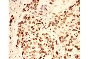 IHC-P: BRCA1 antibody testing of human breast cancer tissue (BRCA1 Antikörper  (AA 1661-1863))
