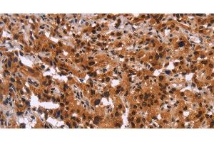 Immunohistochemistry of paraffin-embedded Human thyroid cancer using GPR124 Polyclonal Antibody at dilution of 1:40 (GPR124 Antikörper)