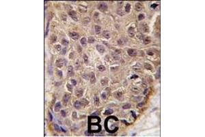 Formalin-fixed and paraffin-embedded human breast carcinoma tissue reacted with OAS1 antibody (C-term), which was peroxidase-conjugated to the secondary antibody, followed by DAB staining. (OAS1 Antikörper  (C-Term))