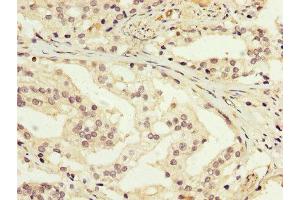 IHC image of ABIN7166949 diluted at 1:200 and staining in paraffin-embedded human prostate cancer performed on a Leica BondTM system. (GDI1 Antikörper  (AA 35-170))