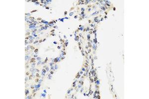 Immunohistochemistry of paraffin-embedded human rectal cancer using CCAR2 antibody (ABIN2563550) at dilution of 1:100 (40x lens). (CCAR2 Antikörper)