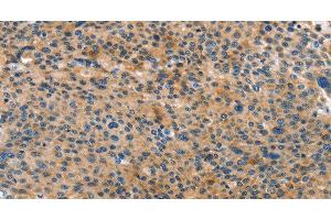 Immunohistochemistry of paraffin-embedded Human liver cancer tissue using ANXA10 Polyclonal Antibody at dilution 1:35 (Annexin a10 Antikörper)