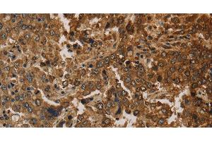 Immunohistochemistry of paraffin-embedded Human liver cancer using CK-16 Polyclonal Antibody at dilution of 1:30 (KRT16 Antikörper)