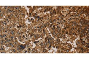 Immunohistochemistry of paraffin-embedded Human liver cancer using CK-16 Polyclonal Antibody at dilution of 1:30