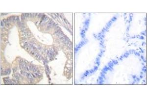 Immunohistochemistry analysis of paraffin-embedded human colon carcinoma tissue, using Gastrin Antibody.